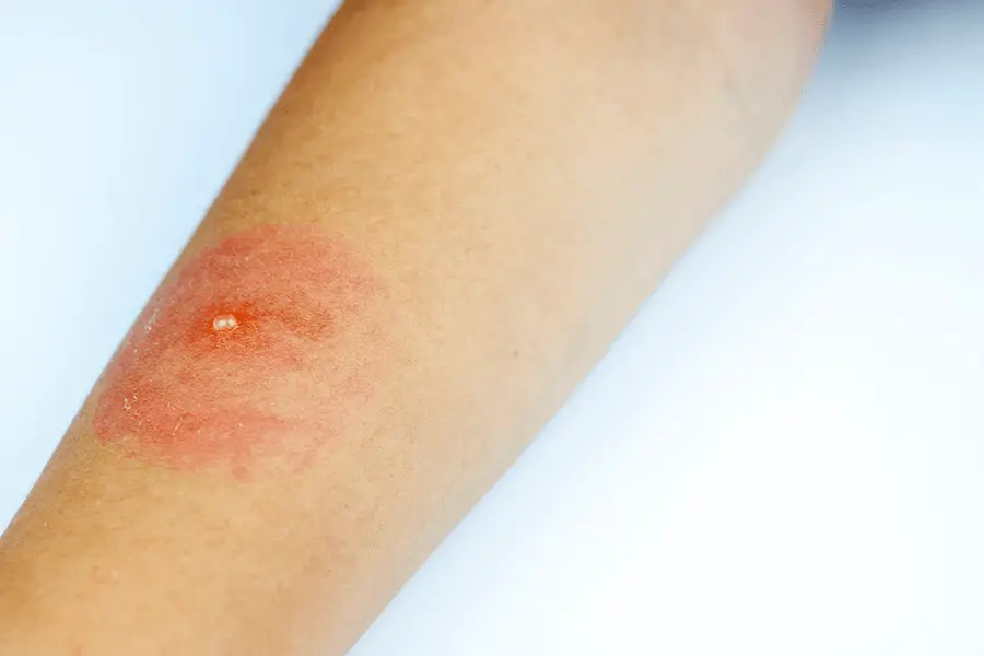 Allergic reactions to insect stings